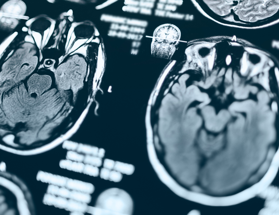 Important Lessons from the EVOKE Alzheimer’s Clinical Trial with Oral Semaglutide